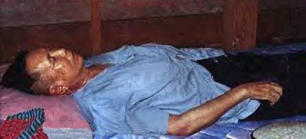 Saloth Sar Alias POL POT sur son lit de mort